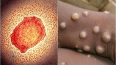Photo of जानें क्या है मंकीपॉक्स के लक्षण, पढ़े पूरी खबर