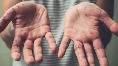 Photo of देश में मिला पहला मंकीपॉक्स का मरीज हुआ ठीक, अस्पताल से मिली छुट्टी