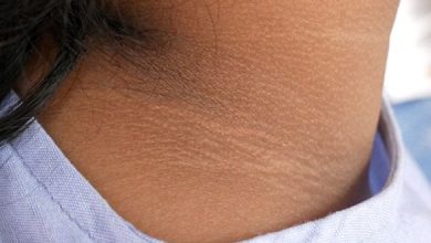 Photo of खतरनाक बीमारी का संकेत देते हैं गर्दन पर दिखने वाले ये निशान ￼