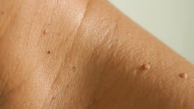 Photo of छोटे-छोटे मस्से देते हैं इन बीमारियों के संकेत