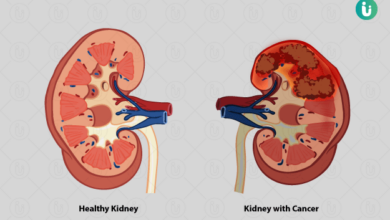 Photo of यहाँ जानिए बच्चो के किडनी कैंसर के लक्षण..