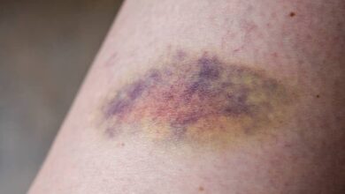 Photo of आइए जानते हैं किन वजहों से पड़ते हैं ये निशान और क्या है इसे दूर करने के उपाय..